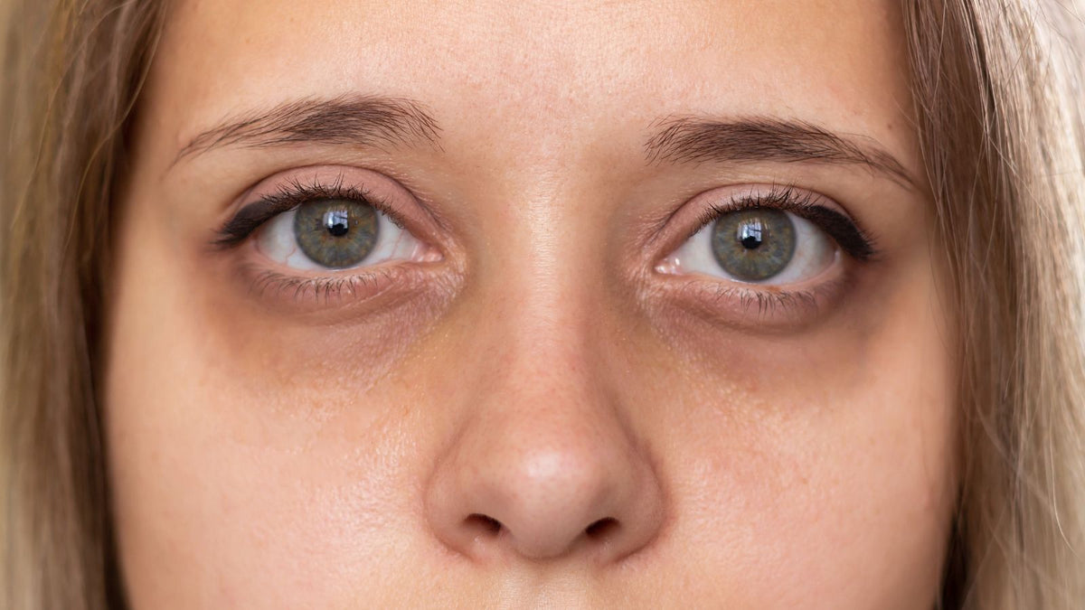 woman with dark circles under her eyes