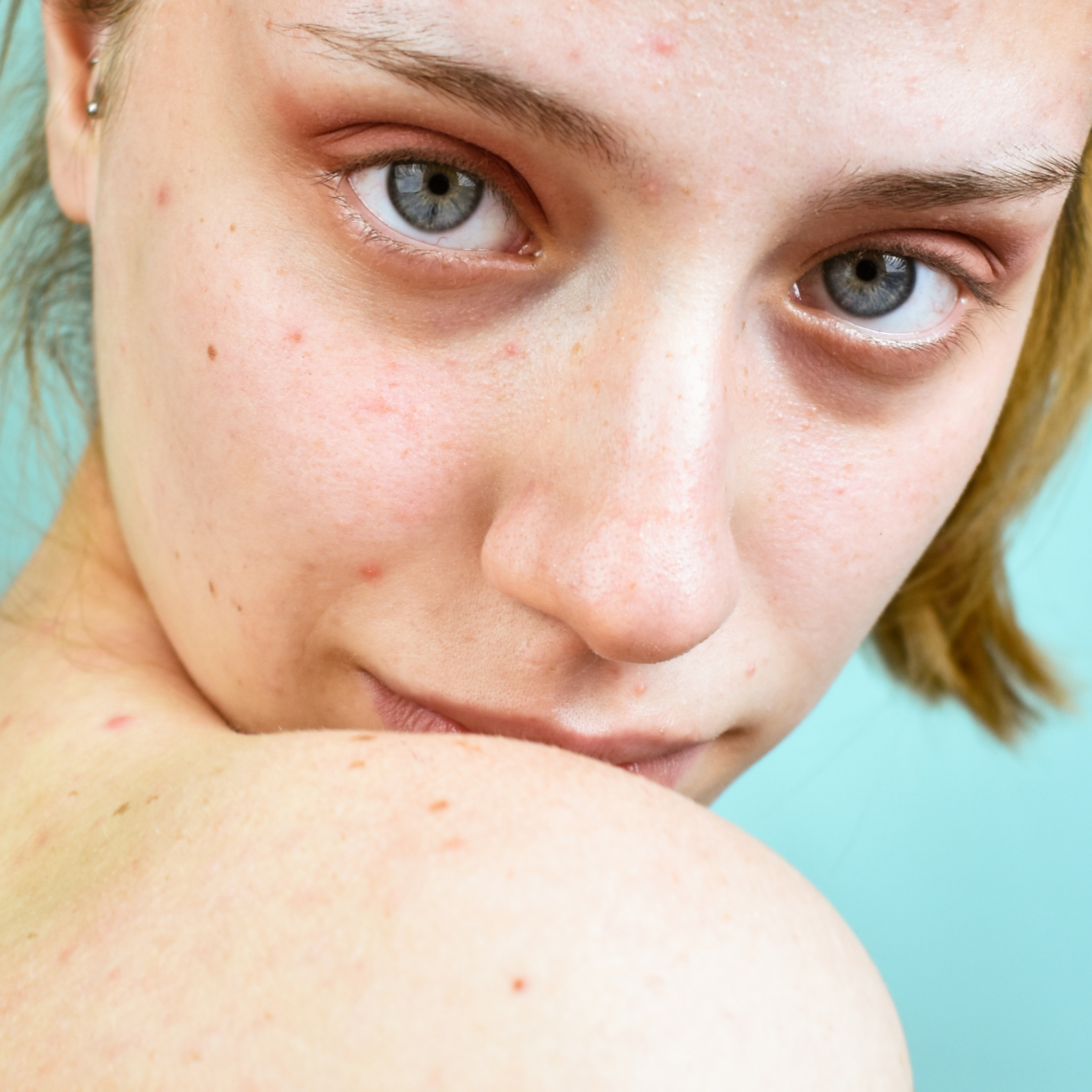 Shine Bright & Clear Routine for Blemish-Prone Teens