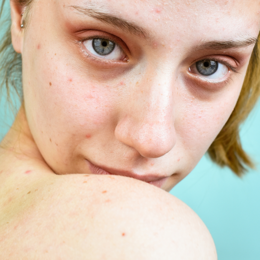 Shine Bright & Clear Routine for Blemish-Prone Teens